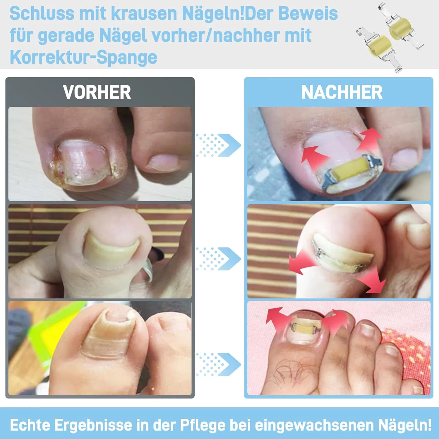 Корректор вросшего ногтя от Ingrown Toenail Correctionary Inhwrior — фото 3