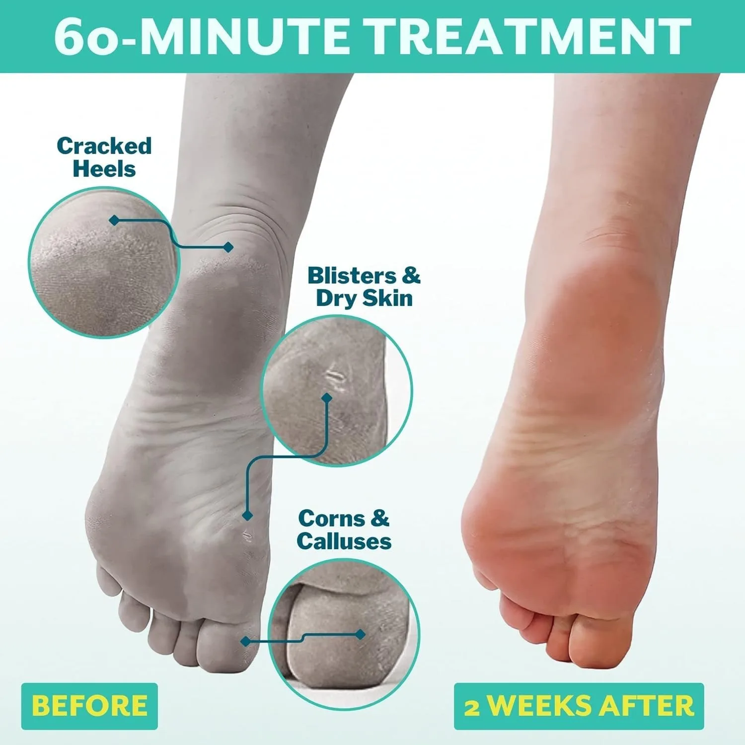 Patchology PoshPeel Pedi Cure - маска-пилинг для ног, отшелушивающая маска для ног, педикюрные носочки с глубоким отшелушиванием для нежной, как у младенца, принадлежности для ухода за ногами, 1 пара 1 штука (1 шт.) — фото 3