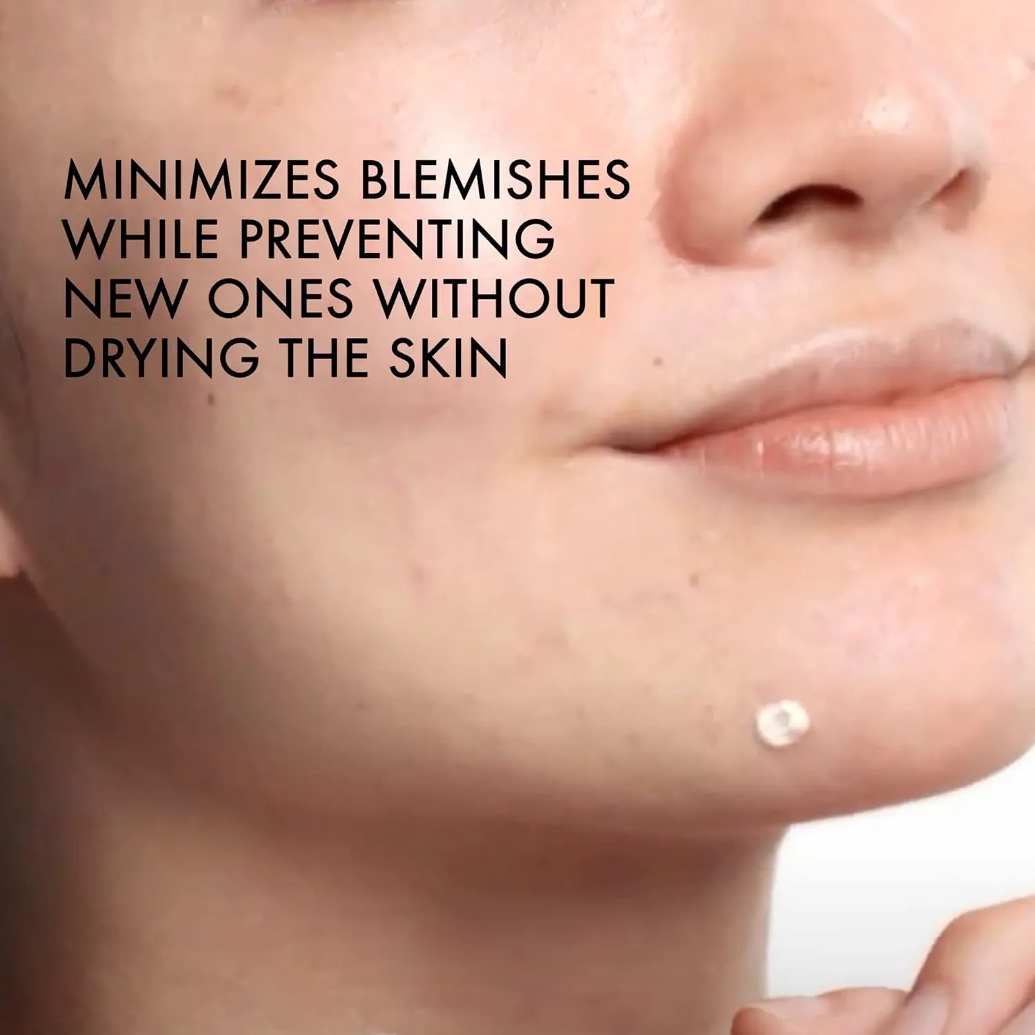 Пилинг Vichy — Normaderm SOS Acne Rescue Spot Corrector - средство для точечного лечения акне на лице с — фото 4