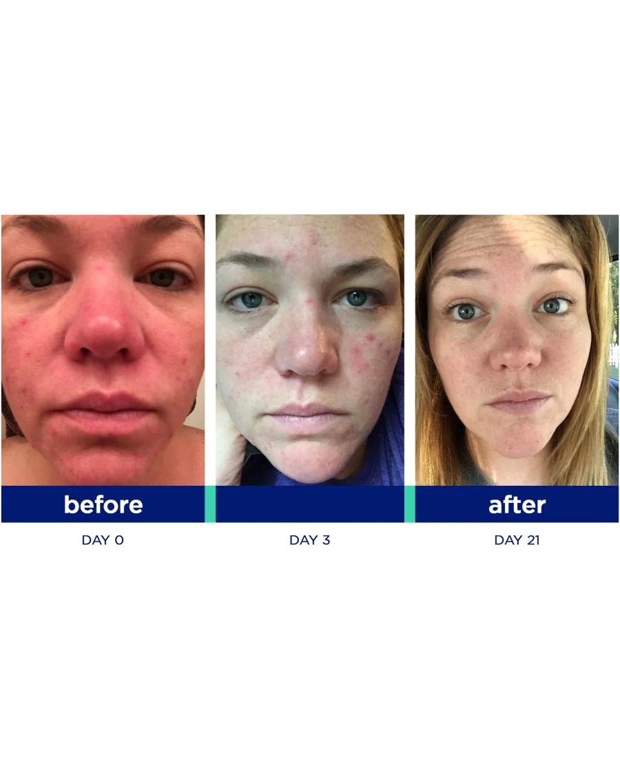Skinkick Система Blemish Kick Duo — фото 4