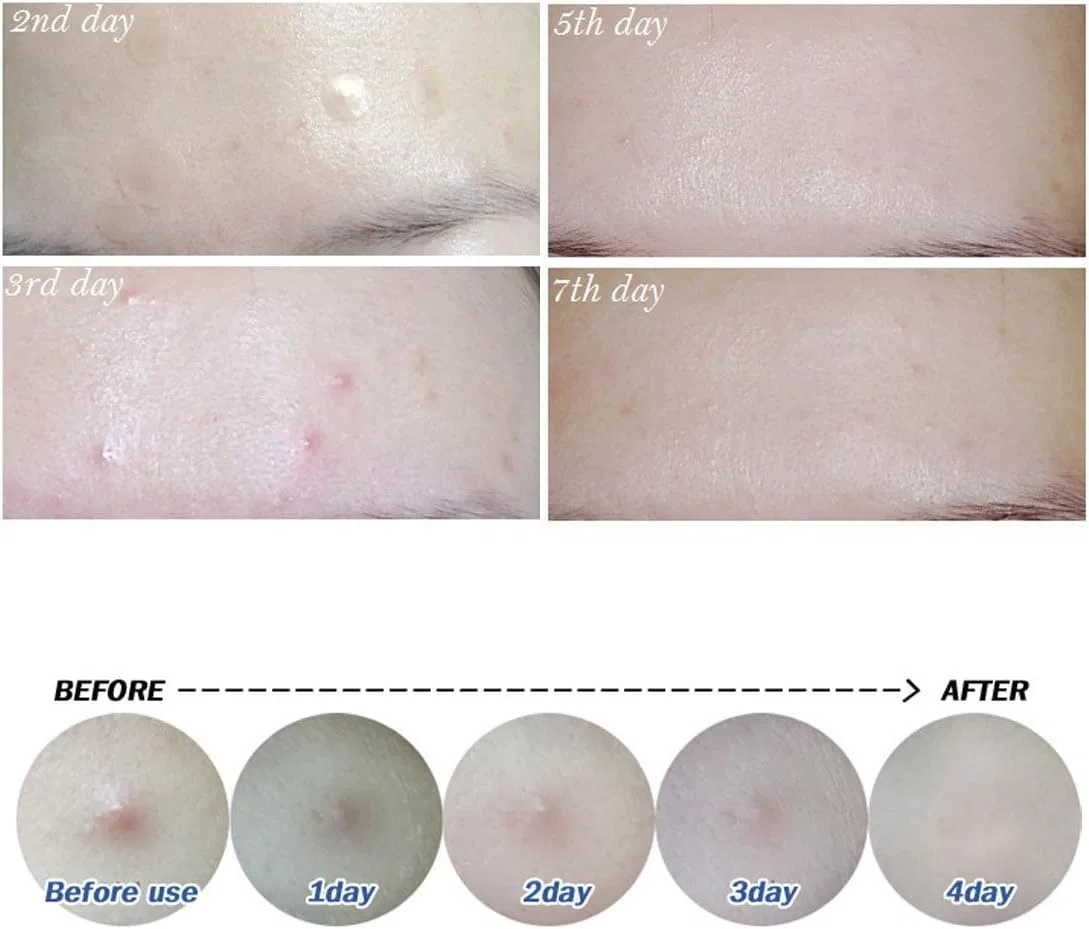Патчи для проблемной кожи Neoderm прозрачные 10 упаковок по 80 патчей — фото 3