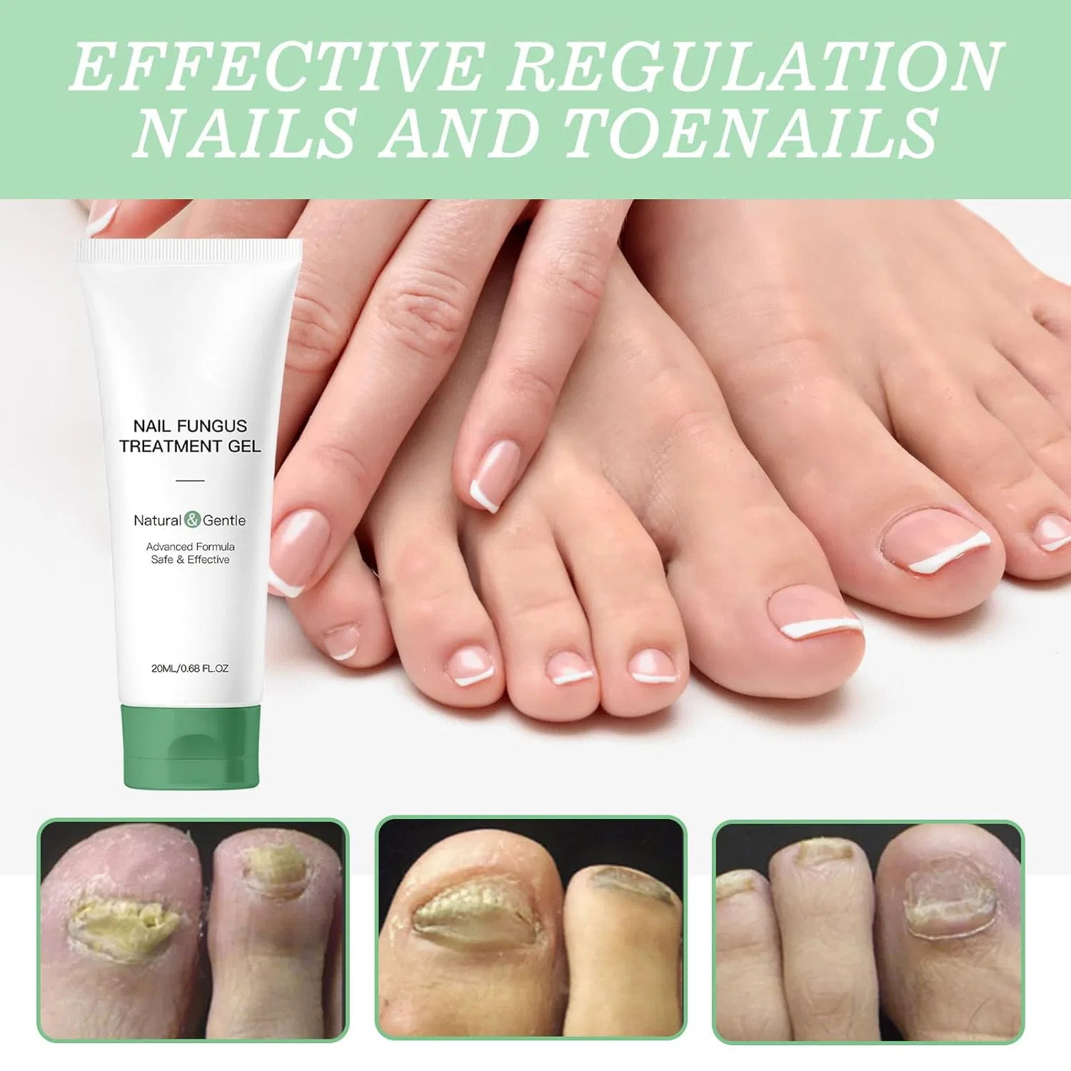 Гель для ухода за ногтями «Nagelpilz Nail FungusTreatment» от Dermafix ‎Ailisk, 2Pcs — фото 3